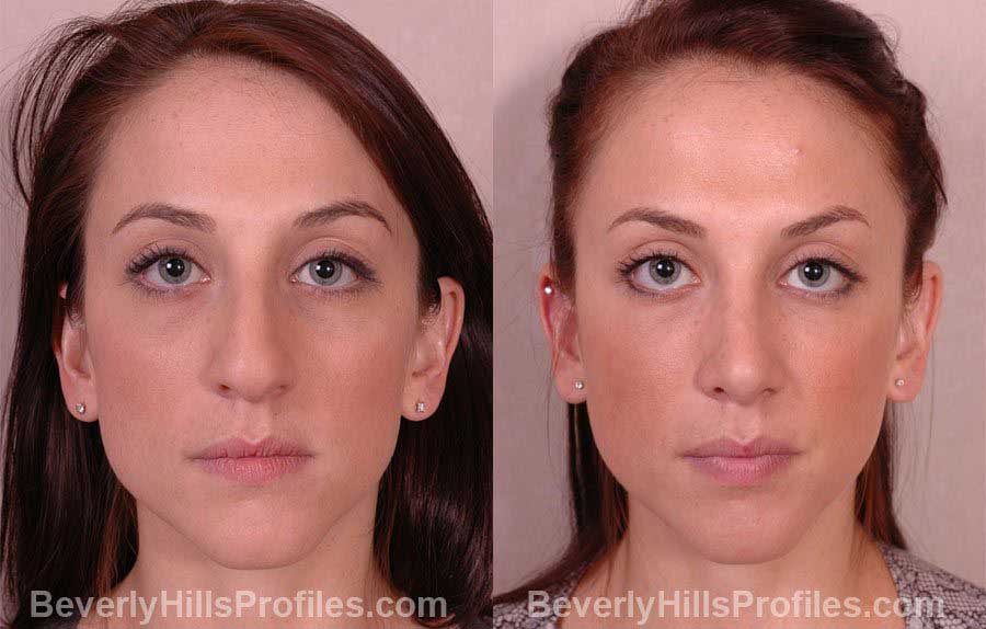 Female patient before and after Nose Job front photos