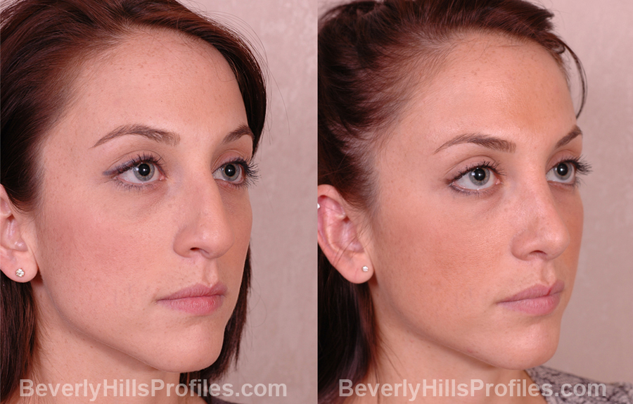 Rhinoplasty Before and After Photo - female, right oblique view