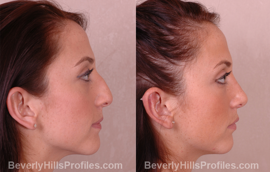 Female patient before and after Nose Job side photos