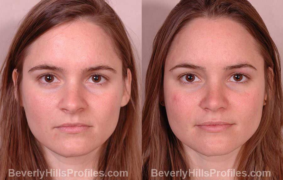 photos Female before and after Nose Job - front view