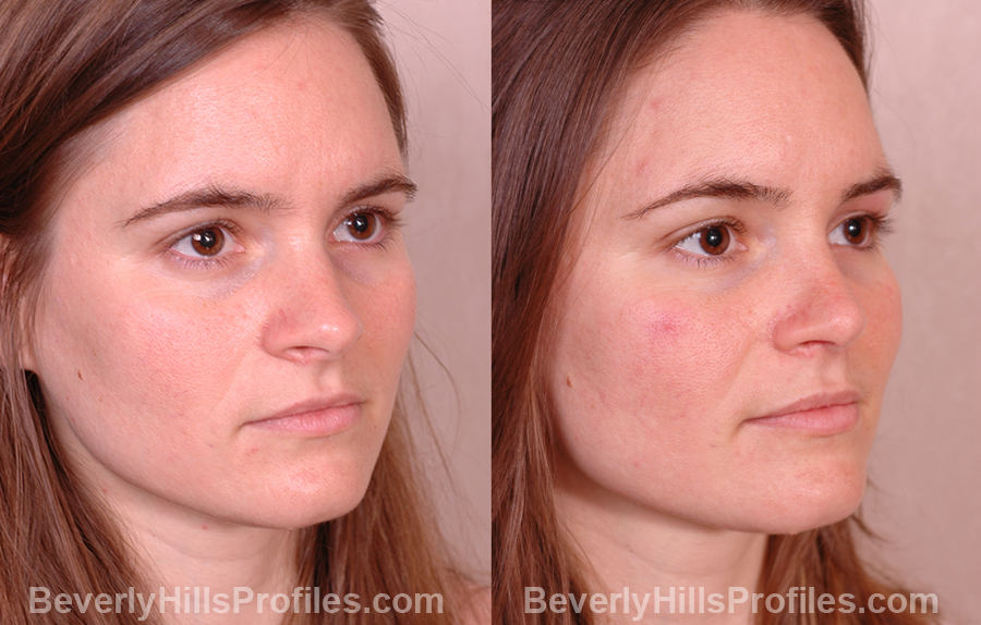 photos Female before and after Nose Job - oblique view