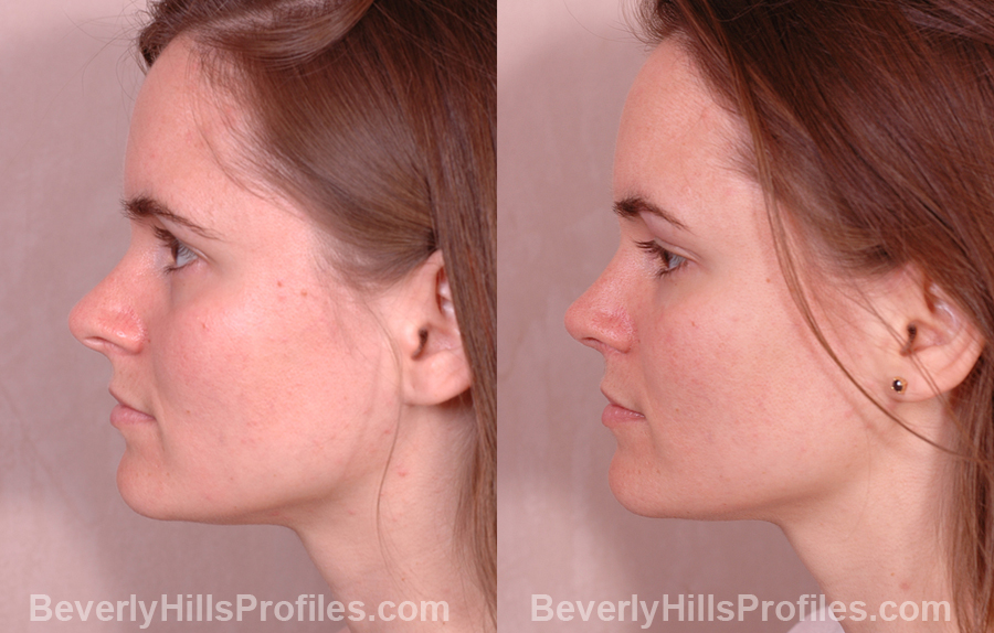 photos Female before and after Nose Job - side view