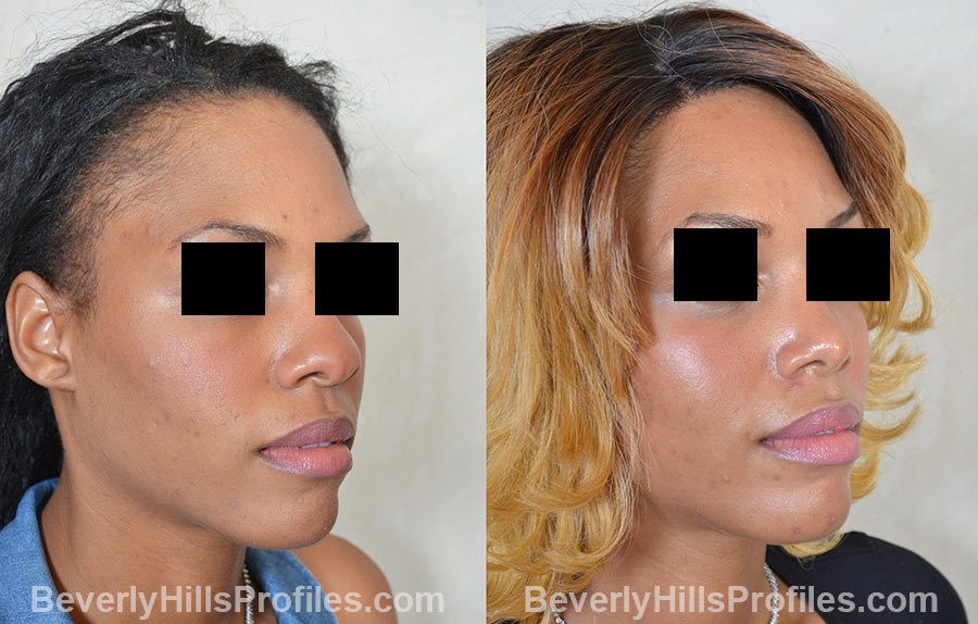 Female before and after Rhinoplasty, oblique view