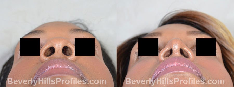 Female before and after Rhinoplasty, photo