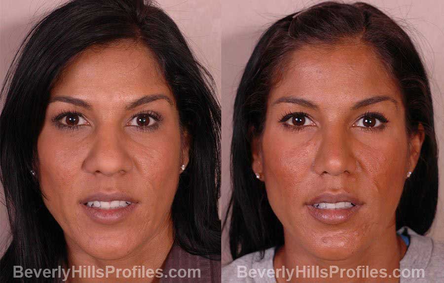 pics Female before and after Nose Job - front view