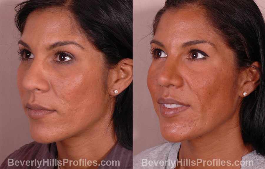 pics Female before and after Nose Job - oblique view