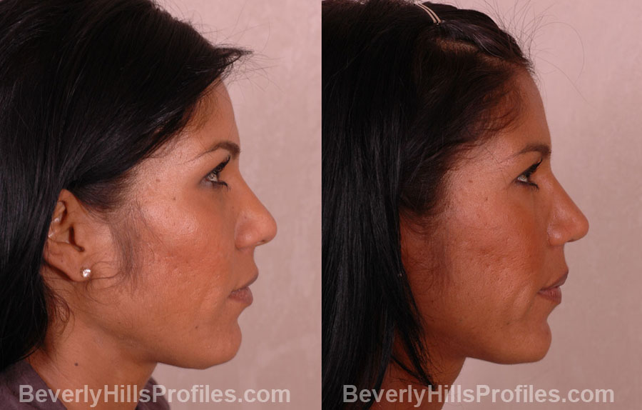 pics Female before and after Nose Job - side view