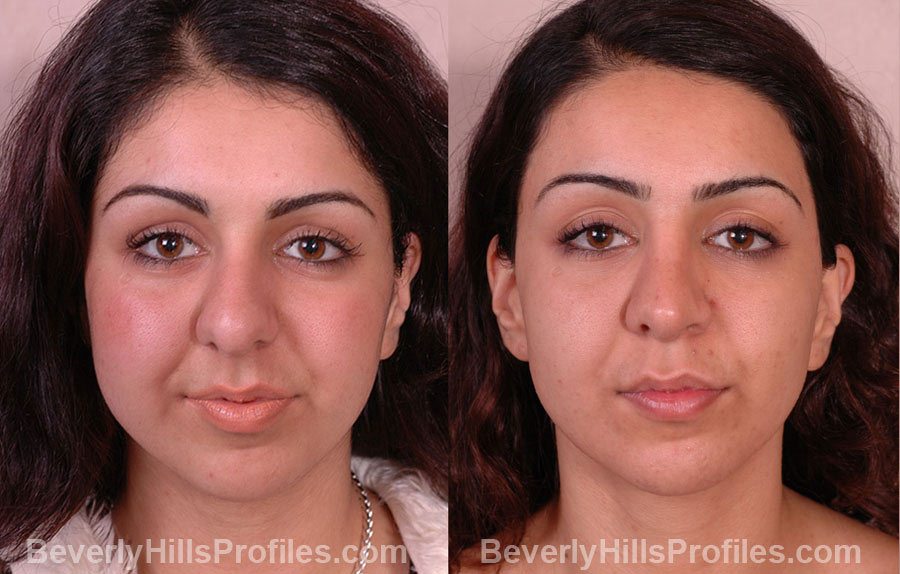 imgs Female before and after Nose Job - front view