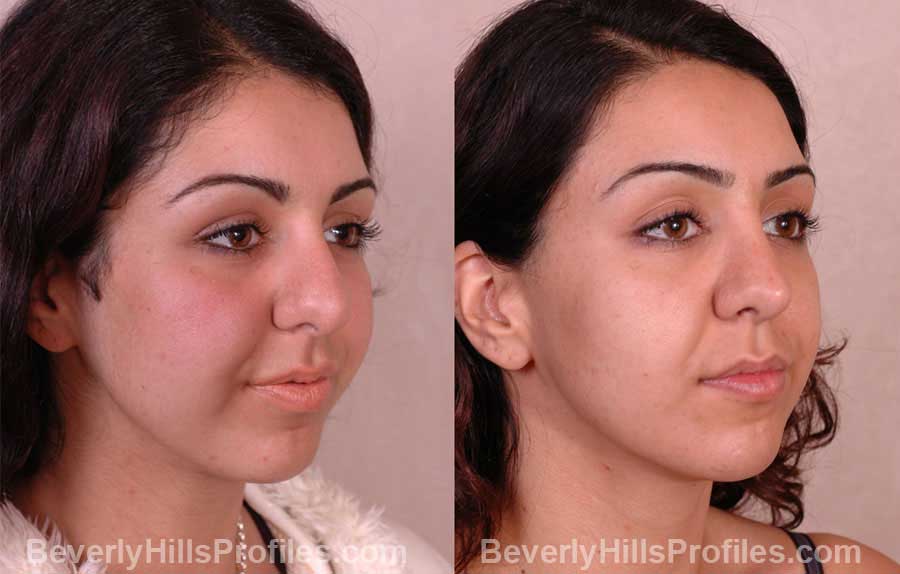 imgs Female before and after Nose Job - front view