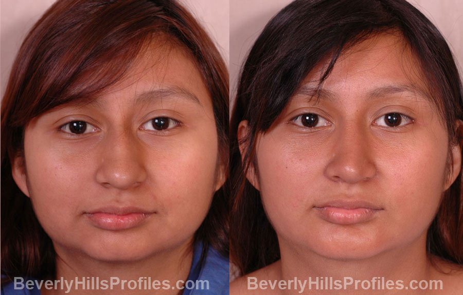 pics Female before and after Nose Job front view