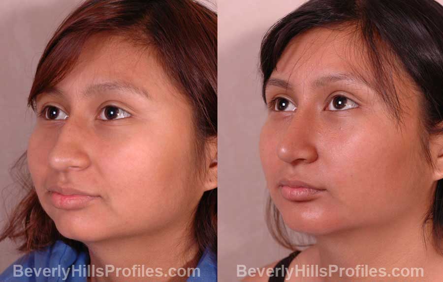 pics Female before and after Nose Job oblique view