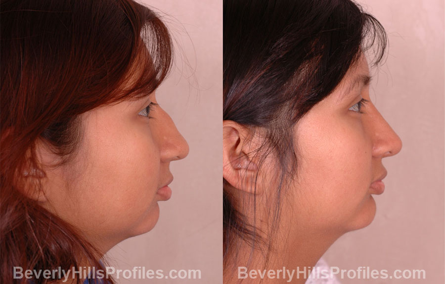 pics Female before and after Nose Job side view