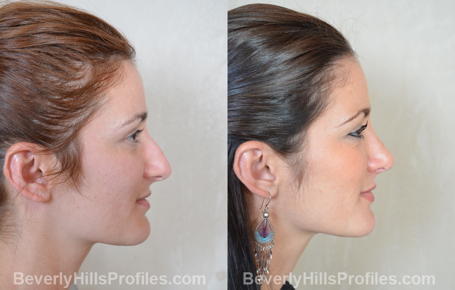 imgs Female before and after Nose Job side view