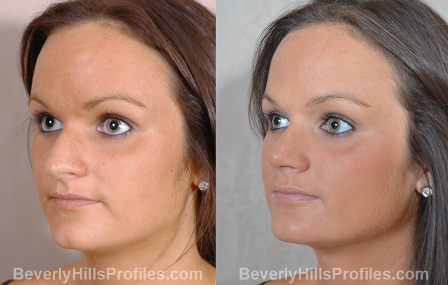 Female patient before and after Nose Job, oblique view