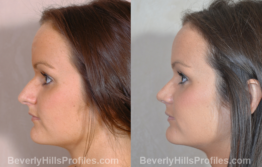 Female patient before and after Nose Job, side view