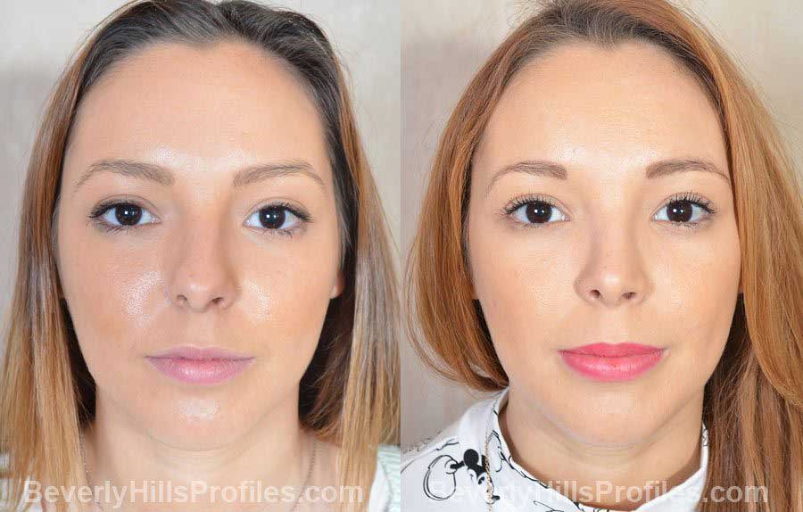 Photos Female patient before after Nose Job front view