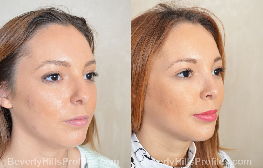 Photos Female patient before after Nose Job oblique view