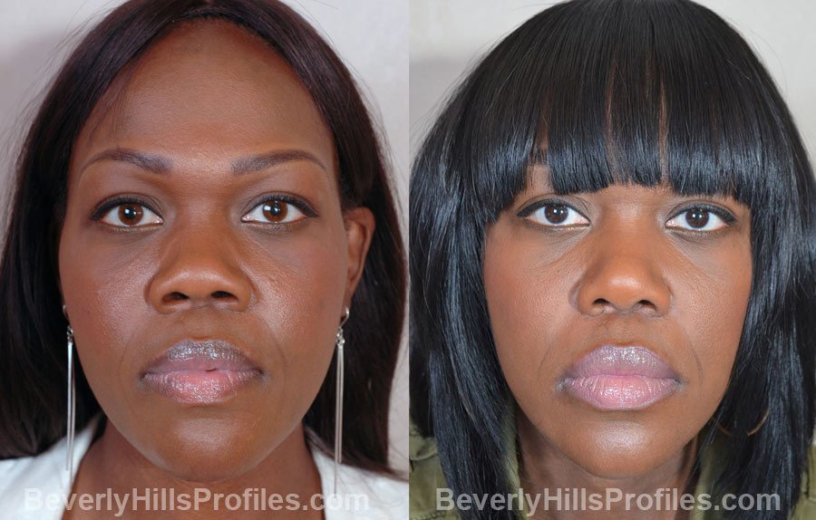Female face before and after RHINOPLASTY SURGERY treatment, nose, patient 2 (front view)