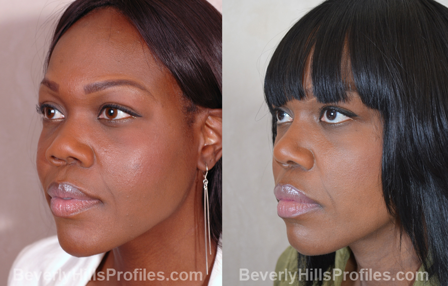 Female before and after Nose Surgery side view