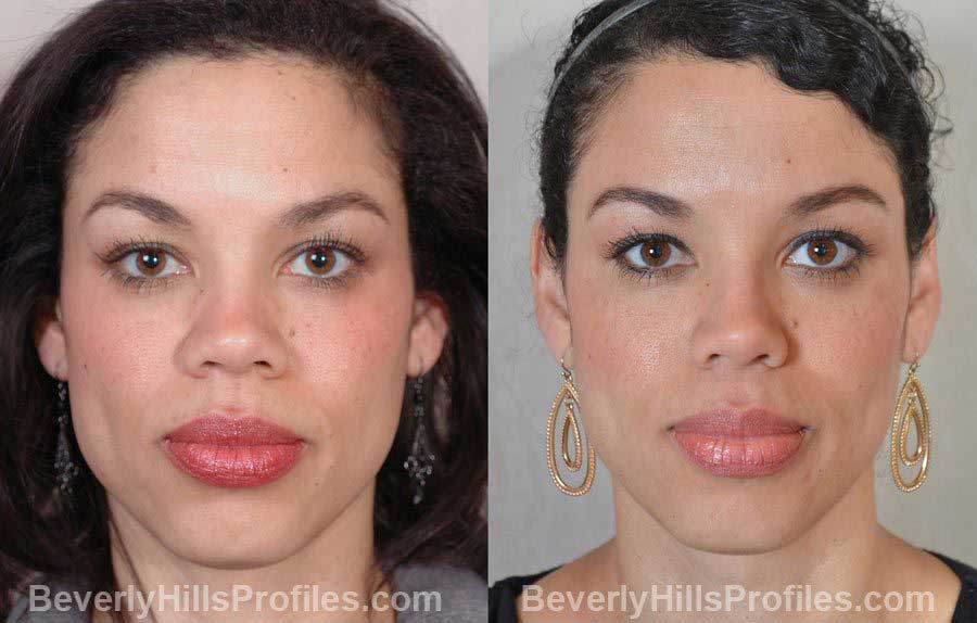 Female before and after Nose Surgery, front view