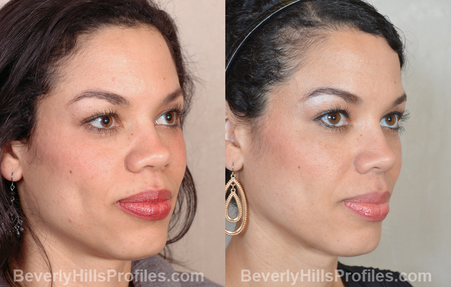Female before and after Nose Surgery, oblique view