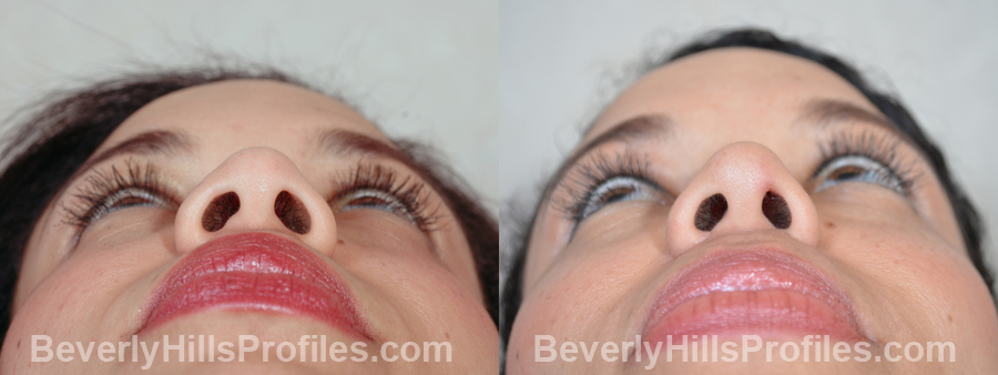 Female before and after Nose Surgery, underside view