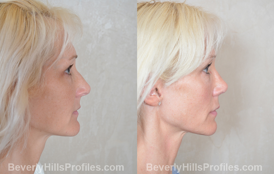 Female before and after Nose Surgery - side view