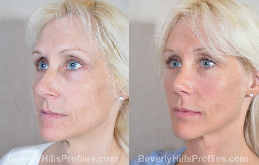 Female before and after Nose Surgery - oblique view