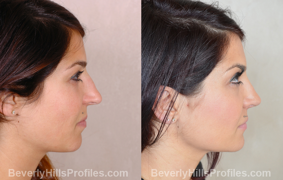 photos Female before and after Nose Surgery - side view