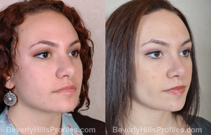 pics Female before and after Nose Surgery - oblique view