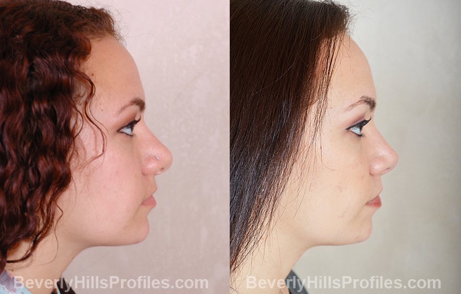 pics Female before and after Nose Surgery - side view