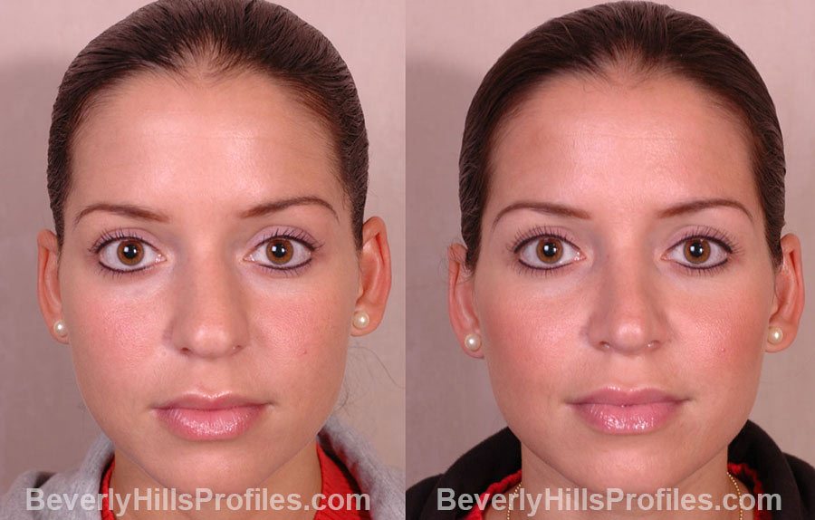 Female face before and after RHINOPLASTY SURGERY treatment, nose, patient 1 (front view)