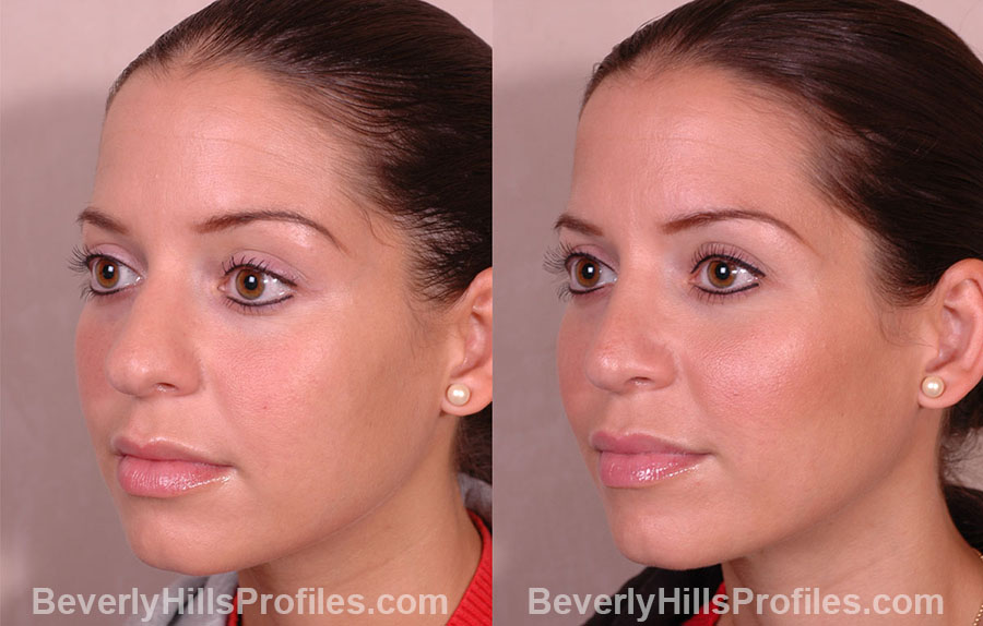 oblique view Female before and after Rhinoplasty