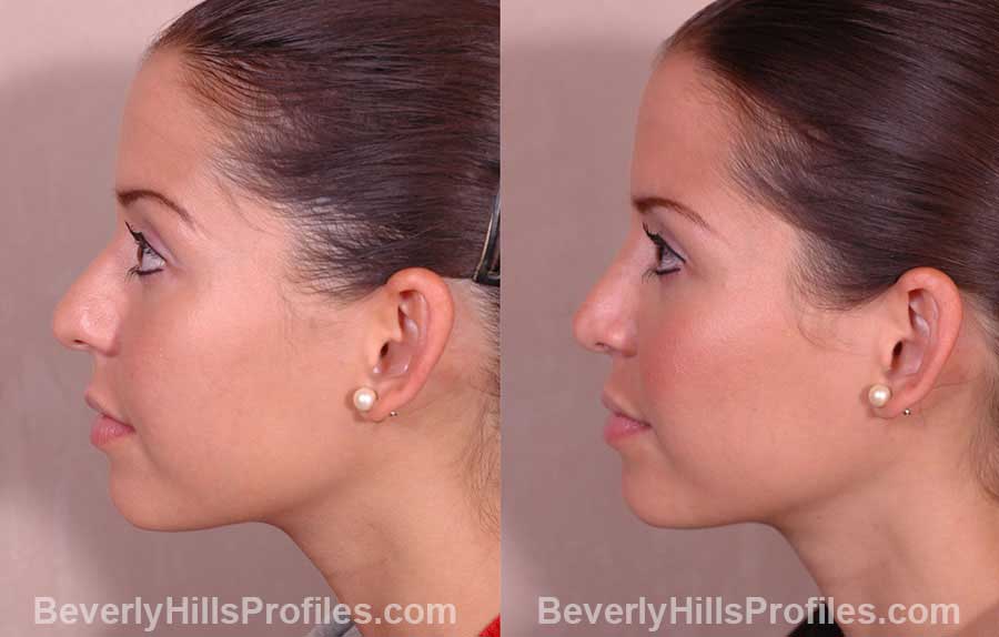 side view Female before and after Rhinoplasty