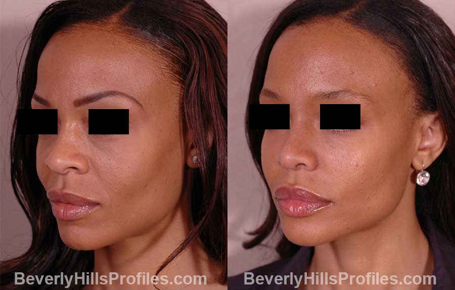 front view - Female before and after Rhinoplasty