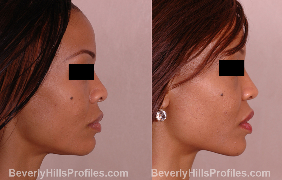 side view - Female before and after Rhinoplasty