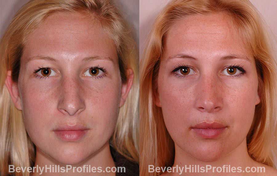front view - Female patient before and after Rhinoplasty