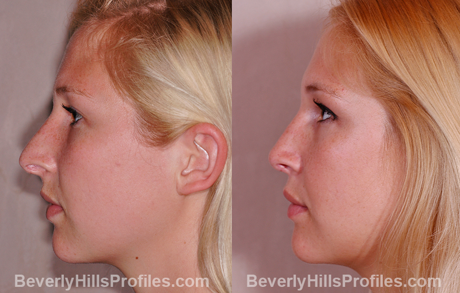 side view - Female patient before and after Rhinoplasty