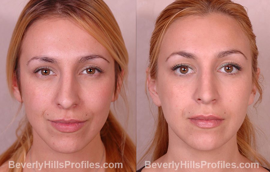 front view, Female patient before and after Rhinoplasty
