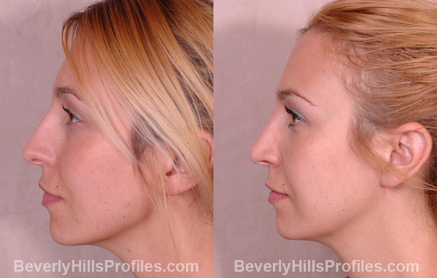 side view, Female patient before and after Rhinoplasty