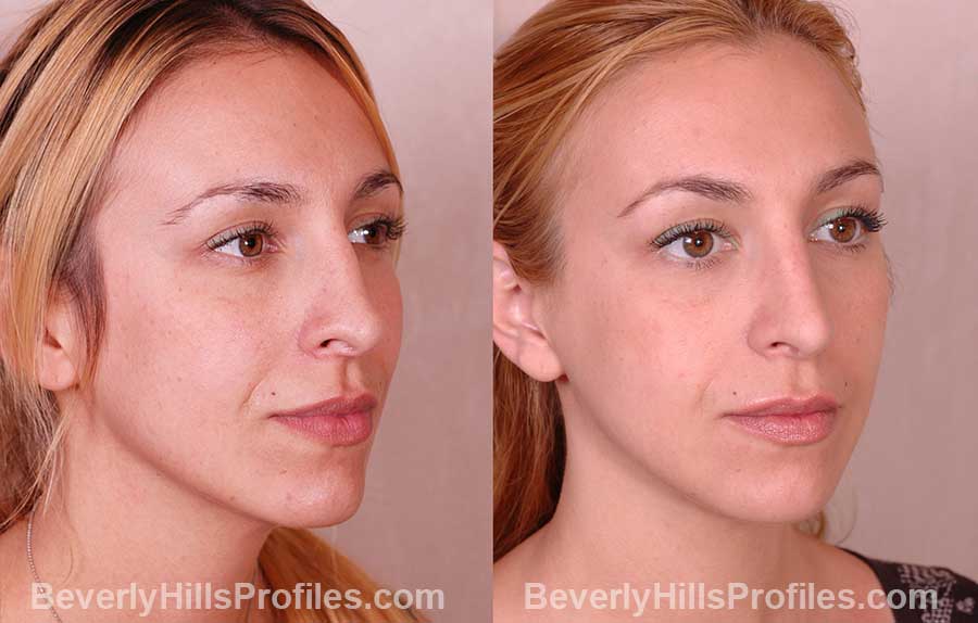 front view, Female patient before and after Rhinoplasty