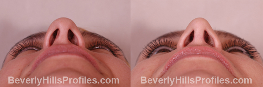 photos, Female patient before and after Rhinoplasty
