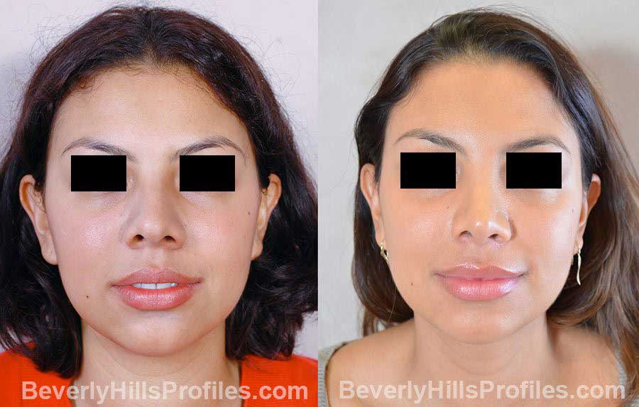 Woman's face, before and after Rhinoplasty treatment, front view, patient 74
