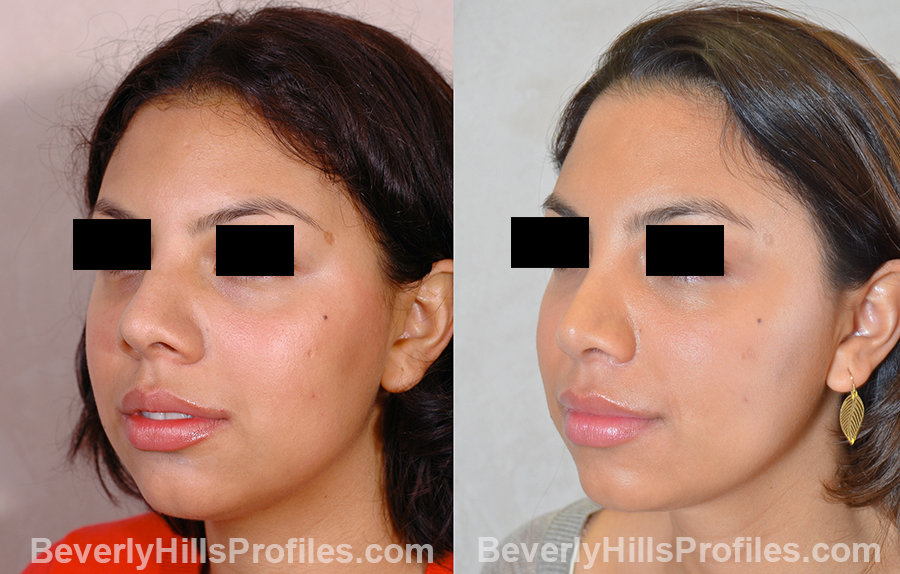 pics Female before and after Nose Surgery oblique view