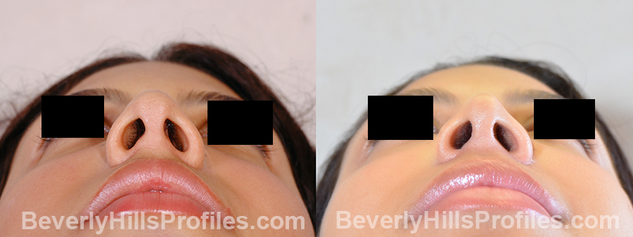 pics Female before and after Nose Surgery underside view