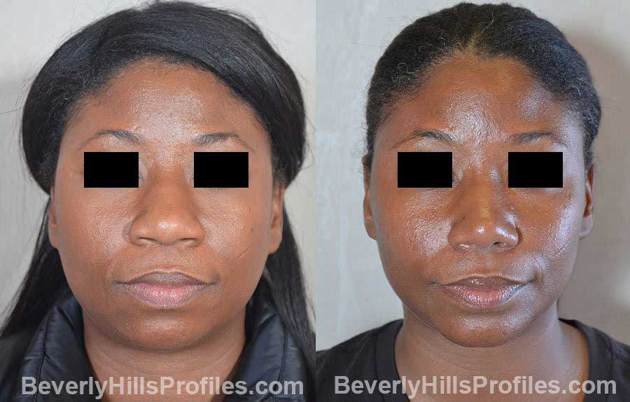 Female patient before and after Nose Surgery front view