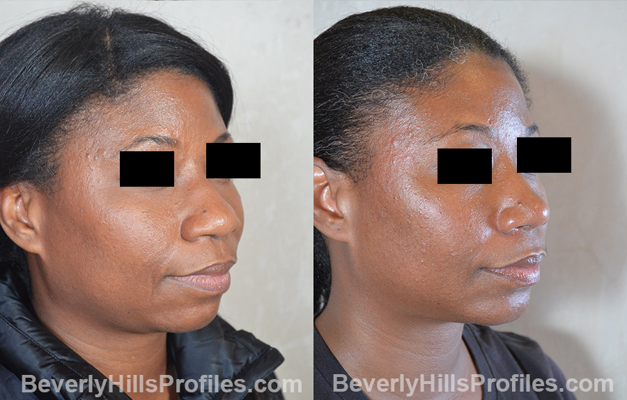 Female patient before and after Nose Surgery oblique view