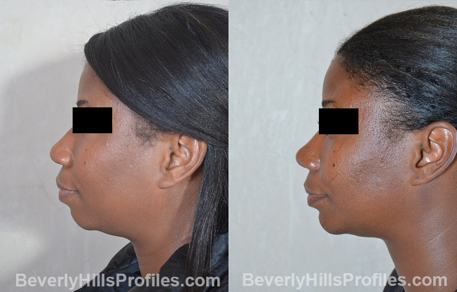 Female patient before and after Nose Surgery side view