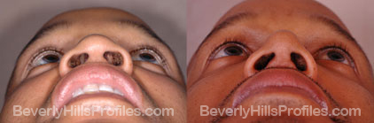 Male nose, before and after African American Rhinoplasty treatment, underside view - patient 3