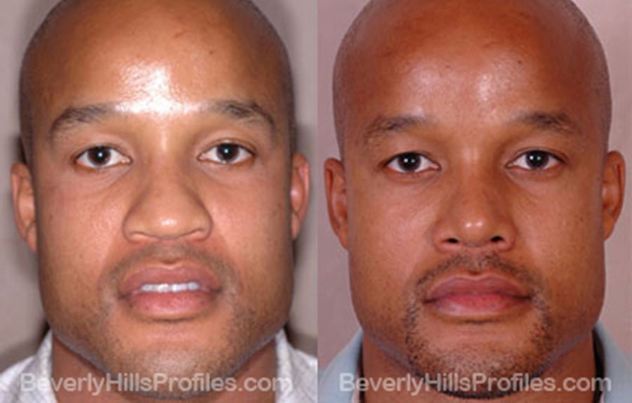 Rhinoplasty 5